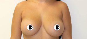 Breast Augmentation | Dr Diaco | After
