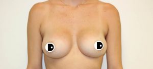 Breast Augmentation | Dr Diaco | After