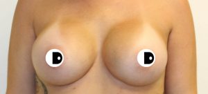 Breast Augmentation | Dr Diaco | After