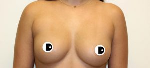 Breast Augmentation | Dr Diaco | Before