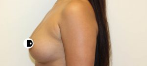 Breast Augmentation | Dr Diaco | Before