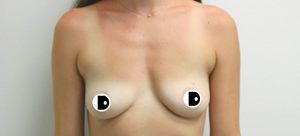 Breast Augmentation | Dr Diaco | Before
