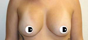 Breast Augmentation | Dr Diaco | Before